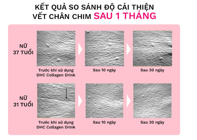 Cải thiện vết chân chim sau 1 tháng sử dụng nước uống collagen DHC Beauty 7000